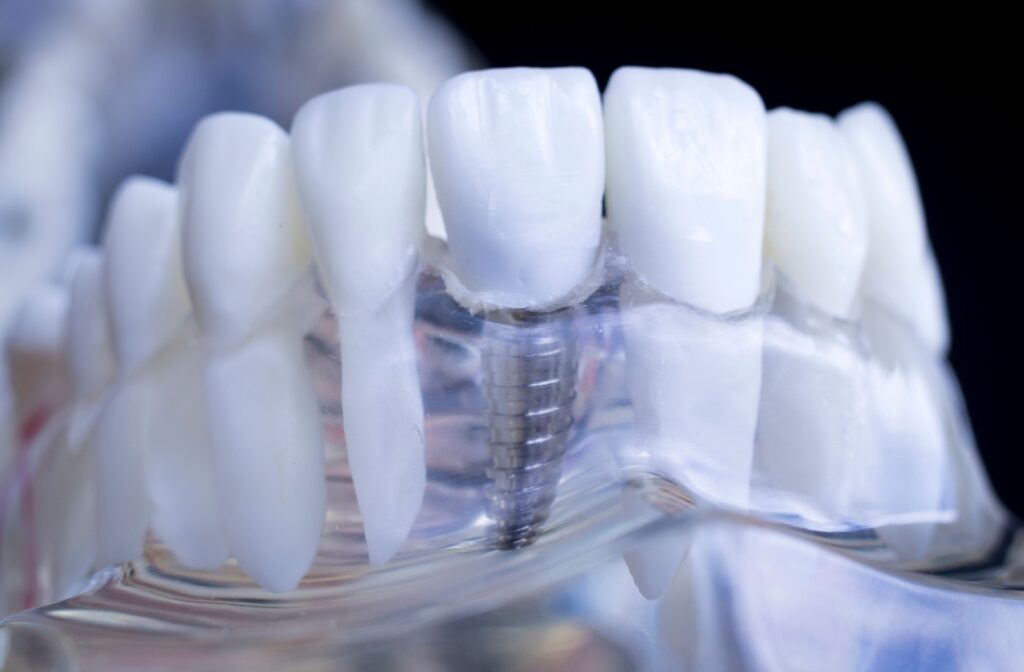 A close-up of a plastic model of the lower half of a person's jaw, displaying how dental implants are placed. The gum portion of the model is clear, and shows a metal anchor placed inside as an attachment point for an artificial tooth.