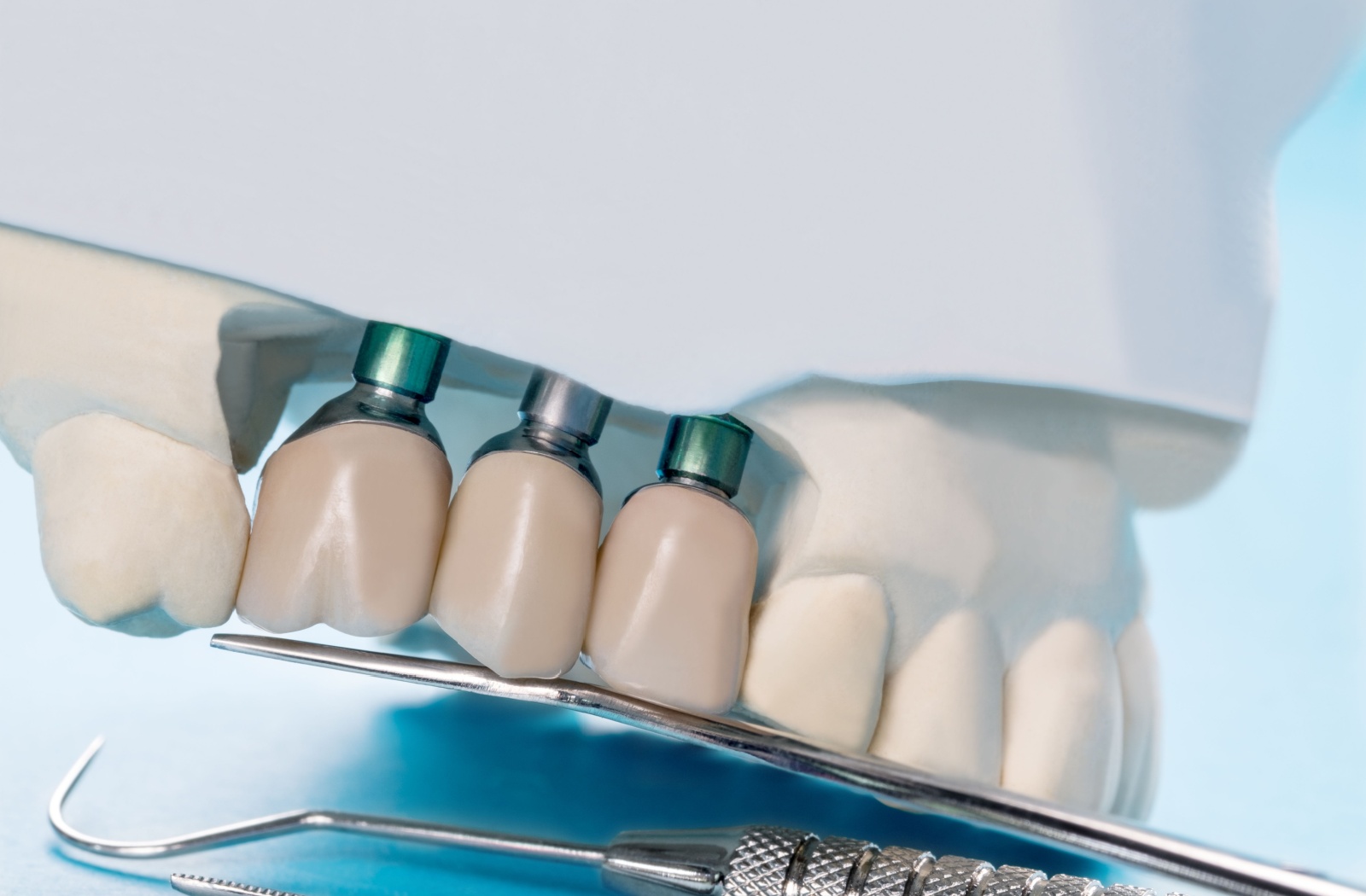 A close-up of a plastic model of the upper half of a person's mouth. The gum section has been removed, displaying three metal anchors for dental implants, with an artificial tooth attached to each.