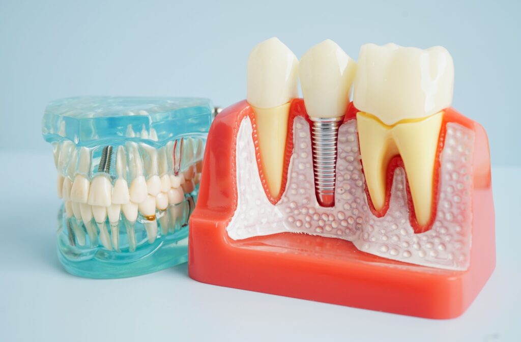 Two close-up dental implant models.