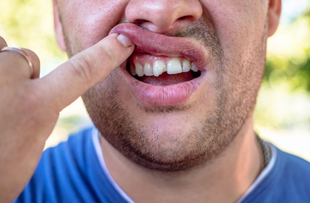 A close-up of a person in a blue shirt lifting their lip to reveal a chipped front tooth highlighting the damage clearly