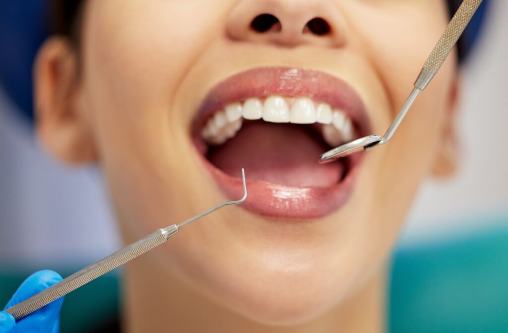 A dentist uses a mirror and scaler to clean a patient's teeth at a routine dental cleaning appointment.