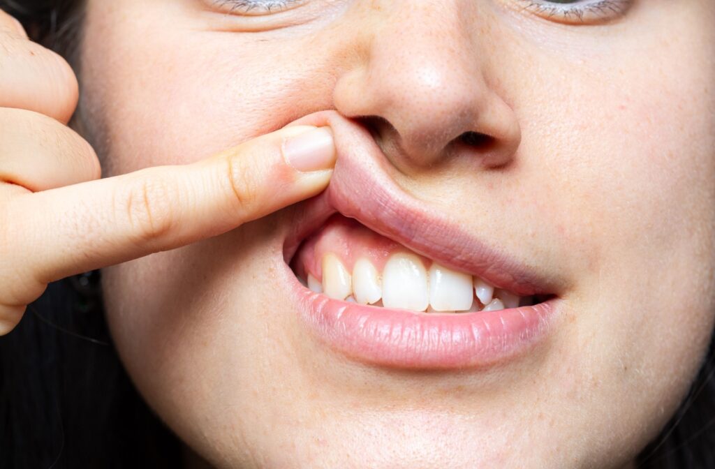 A person lifting their lip to show their gum line