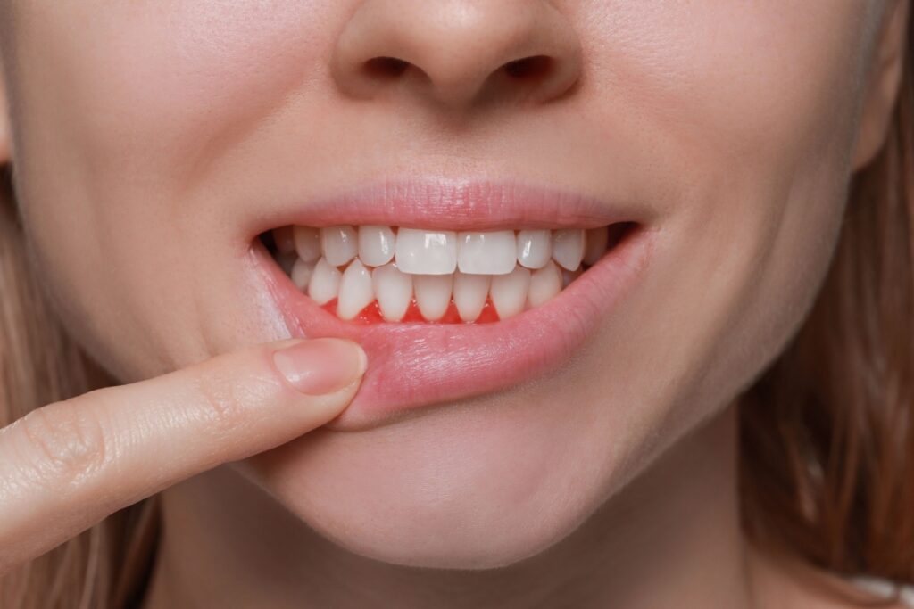 A person pulling their bottom lip down to show their gum disease